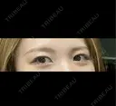 二重埋没 湘南美容クリニック 静岡院 BEFORE サムネイル用