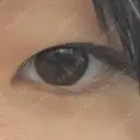 ヒアルロン酸注入（涙袋） 銀座リシェスクリニック BEFORE サムネイル用