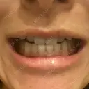 ホワイトニング 緑のテラス歯科クリニック BEFORE サムネイル用