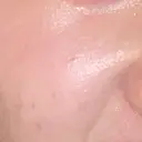 ピーリング（ハリ・ツヤ） リアラクリニック 名古屋院 BEFORE サムネイル用