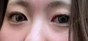 二重切開 / 目頭切開 / クマ治療 / 目尻切開 EMMA CLINIC（エマクリニック） BEFORE サムネイル用