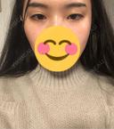 目頭切開 / 眼瞼下垂（切開） Otus Clinic 【オータスクリニック】 BEFORE サムネイル用