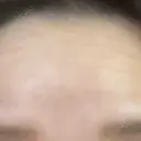 ボトックス（額） / その他（鼻） TCB東京中央美容外科 盛岡院 BEFORE サムネイル用