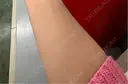 白玉点滴・注射 美容皮膚科エルムクリニック 麻布院 BEFORE サムネイル用