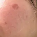 シミ取りレーザー / エレクトロポレーション / 毛穴洗浄（ハイドラフェイシャルなど） まゆりなclinic 名古屋栄 BEFORE サムネイル用
