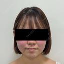 脂肪吸引（顔） / 脂肪吸引注射（顔） SEA CLINIC（シークリニック） BEFORE サムネイル用