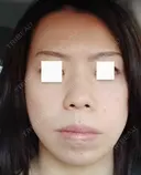 エレクトロポレーション / 毛穴洗浄（ハイドラフェイシャルなど） / 光治療（フォトフェイシャルなど） Leap beauty clinic BEFORE サムネイル用