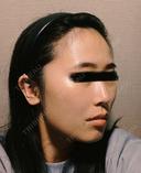 骨切り（あご） / 骨削り（エラ） / 骨削り（頬） セギム美容整形外科 BEFORE サムネイル用