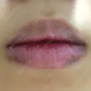 口唇縮小術 / ガミースマイル手術 / 口角挙上 / ボトックス（口角） / その他（口元） 聖心美容クリニック 福岡院 BEFORE サムネイル用