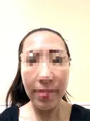 水光注射（ハリ・美肌） / その他（肌） オラクル美容皮膚科 東京新宿院 BEFORE サムネイル用