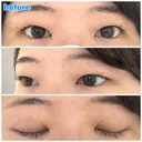 二重埋没 城本クリニック 福岡院 BEFORE サムネイル用