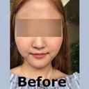 脂肪溶解注射（顔） id美容クリニック 銀座院 BEFORE サムネイル用