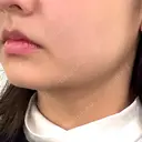 その他（肌） CIEL SKIN CLINIC（シエルスキンクリニック） BEFORE サムネイル用