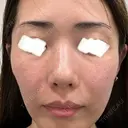 光治療（フォトフェイシャルなど） ミニマムスキンクリニック池袋 BEFORE サムネイル用