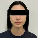 糸リフト / 脂肪吸引（顔） / ジョールファット除去 / 脂肪吸引注射（顔） SEA CLINIC（シークリニック） BEFORE サムネイル用