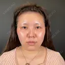 二重埋没 / ヒアルロン酸注入（涙袋） / ヒアルロン酸注入（あご） R Beauty CLINIC 名古屋院 BEFORE サムネイル用