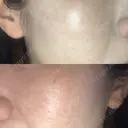 光治療（フォトフェイシャルなど） 小木曽クリニック BEFORE サムネイル用