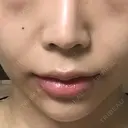 人中短縮 / 口角挙上 清潭女神美容外科 BEFORE サムネイル用