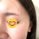 ヒアルロン酸注入（涙袋） / ボトックス（目尻） / ボトックス（額） / ボトックス（ガミースマイル） Code Beauty Clinic 名古屋院 BEFORE サムネイル用