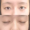 二重埋没 共立美容外科 新宿本院 BEFORE サムネイル用