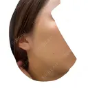 光治療（フォトフェイシャルなど） Lumiera Clinic BEFORE サムネイル用