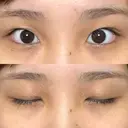 二重切開 / 目頭切開 オーキッド美容クリニック東京御徒町 BEFORE サムネイル用