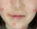 ほくろ・いぼ切除（肌） KARIS beauty clinic BEFORE サムネイル用