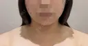 ボトックス（エラ・小顔） / 脂肪溶解注射（顔） おおたかの森ビューティークリニック BEFORE サムネイル用