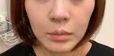 美容点滴・美容注射（美肌） / ヒアルロン酸注入（鼻翼基部） ヴェリテクリニック 大阪院 BEFORE サムネイル用