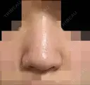 鼻尖形成（切開） / 鼻中隔延長（切開） / 軟骨移植 / 骨切幅寄せ / ワシ鼻修正・ハンプ切除 / 眉間プロテーゼ グロービー美容整形外科 BEFORE サムネイル用