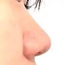 鼻尖形成（切開） / 軟骨移植 / 鼻尖縮小 / 鼻翼基部形成（貴族手術） / ヒアルロン酸注入（鼻翼基部） 東京シンデレラ美容外科 新宿院 BEFORE サムネイル用