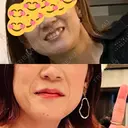 ヒアルロン酸注入（頬） / サーマクール 湘南美容クリニック 仙台院 BEFORE サムネイル用