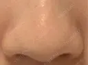 脂肪溶解注射（顔） 東京ロイヤルクリニック BEFORE サムネイル用