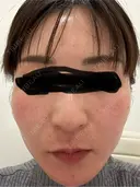 水光注射（ハリ・美肌） オラクル美容皮膚科 東京新宿院 BEFORE サムネイル用