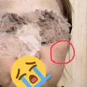 ハイフ（顔） / シミ取りレーザー / エレクトロポレーション 湘南美容クリニック 博多院 BEFORE サムネイル用