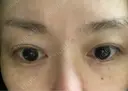 水光注射（ハリ・美肌） オラクル美容皮膚科 東京新宿院 BEFORE サムネイル用