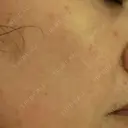 ピコレーザートーニング（美白・肝斑） / フラクショナルレーザー（毛穴・ニキビ跡） ルラ美容クリニック 広島院 BEFORE サムネイル用