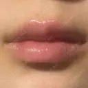 ヒアルロン酸注入（唇） 共立美容外科 大分院 BEFORE サムネイル用