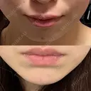 ヒアルロン酸注入（あご） 上野美容外科・美容皮膚科 BEFORE サムネイル用