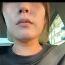 ボトックス（あご） / ボトックス（口角） MAクリニック 心斎橋 BEFORE サムネイル用