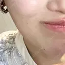 ボトックス（エラ・小顔） 共立美容外科 大阪本院 BEFORE サムネイル用