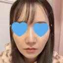 鼻尖形成（切開） / 小鼻縮小（切開） / ワシ鼻修正・ハンプ切除 / 鼻柱下降・鼻唇角形成（猫手術） ASTRA BEAUTY CLINIC BEFORE サムネイル用