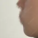 ボトックス（あご） / ボトックス（エラ・小顔） 美容皮膚科エルムクリニック 大阪院 BEFORE サムネイル用