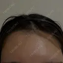 ヒアルロン酸注入（額） / ボトックス（眉間） PRO CLINIC プロクリニック 銀座院 BEFORE サムネイル用