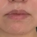 ヒアルロン酸注入（唇） / ボトックス（口角） 上野美容外科・美容皮膚科 BEFORE サムネイル用