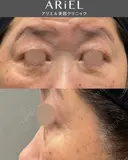 下まぶたたるみ取り / 下まぶたの脂肪取り / 脂肪注入（目の下） アリエル美容クリニック 郡山院 BEFORE サムネイル用