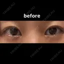 目尻切開 こまちクリニック BEFORE サムネイル用