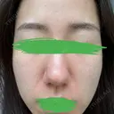 ピコレーザートーニング（美白・肝斑） / ピコフラクショナルレーザー（毛穴・ニキビ跡） おおかみ美容のクリニック 新宿院 BEFORE サムネイル用