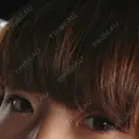 二重埋没 城本クリニック 姫路院 BEFORE サムネイル用