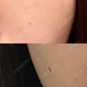 ほくろ・いぼ切除（肌） Belle Via Skin Clinic BEFORE サムネイル用